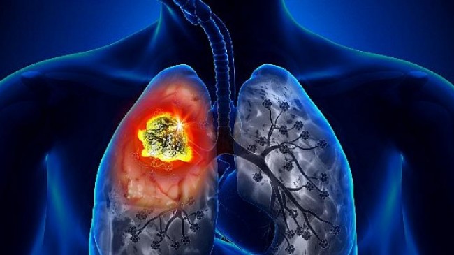 Akciğer Kanseri Dünya Genelinde En Sık Görülen Kanser Türü