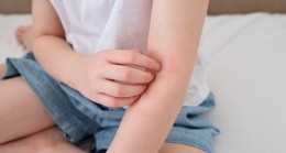 Çocuklarda 'Alerjik Hastalıklar' Hakkında Doğru Sanılan 8 Hatalı Bilgi!