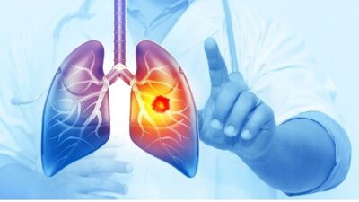 Akciğer kanseri, bilindiği gibi tüm dünyada en fazla karşılaşılan kanser