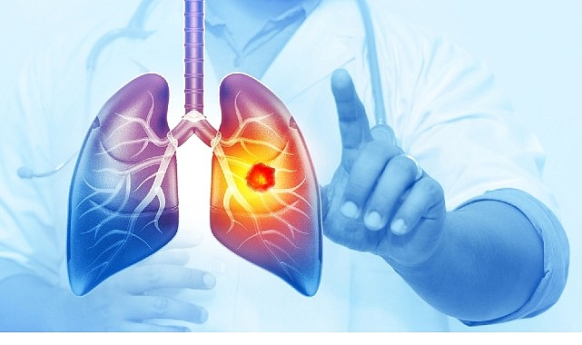 Akciğer kanseri, bilindiği gibi tüm dünyada en fazla karşılaşılan kanser