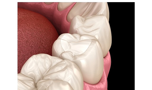 Günümüzde en sık tercih edilen dolgu türleri arasında yer alan